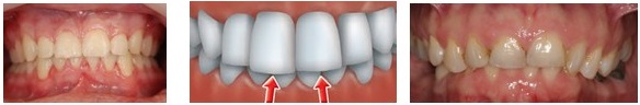 Treatment of deep bite by cosmetic crowns