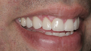 best Cosmetic Dentistry in bangalore