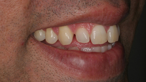 Cosmetic Dentistry in india