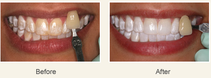 dental fluorosis treatment in Bangalore