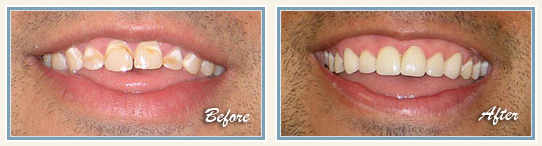 Micro abrasion & tooth bleaching in Bangalore
