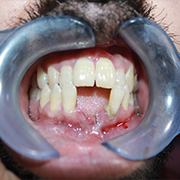 close teeth gaps