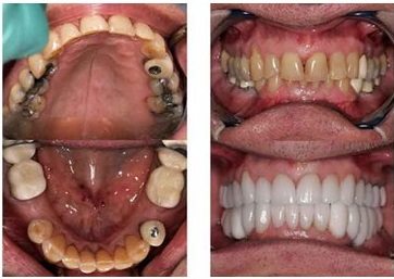 How to Correct an Overbite (or Deep Bite) - Wilkinson Dental